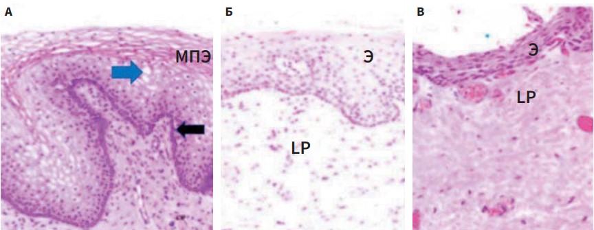 РИС. 1. Атрофические изменения влагалища в период менопаузы на тканевом уровне. А — стенка влагалища при нормальном уровне эстрогенов, многослойный плоский эпителий (МПЭ) богат гликогеном (голубая стрелка указывает на клетки со скоплением гликогена) и не кератинизирован, базальный слой состоит из одного ряда столбчатых клеток; Б — умеренные атрофические изменения, эпителий (Э) истончен, клетки незрелые, имеют меньший размер и меньшее количество цитоплазмы; Г — выраженная атрофия влагалища; LP — lamina propria (собственная пластинка слизистой оболочки) [7]